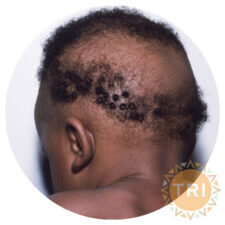 Alopecia_sample
