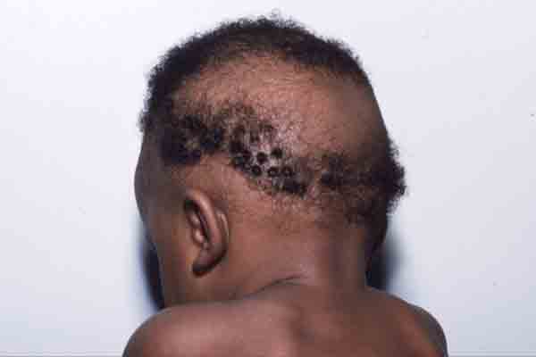 Alopecia